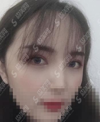 凉山州第二人民医院整形科实力好到离谱,面部拉皮手术果让你折服