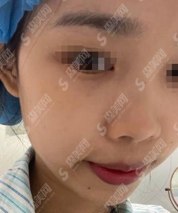 蚌埠医学院第一附属医院整形科做的隆鼻案例好不好?案例前后果对比让人动容