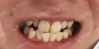 武大口腔医院牙齿矫正价格表,附真实案例分享及恢复详情