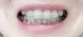 武大口腔医院牙齿矫正价格表,附真实案例分享及恢复详情