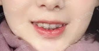 武大口腔医院牙齿矫正价格表,附真实案例分享及恢复详情