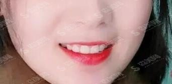 武大口腔医院牙齿矫正价格表,附真实案例分享及恢复详情