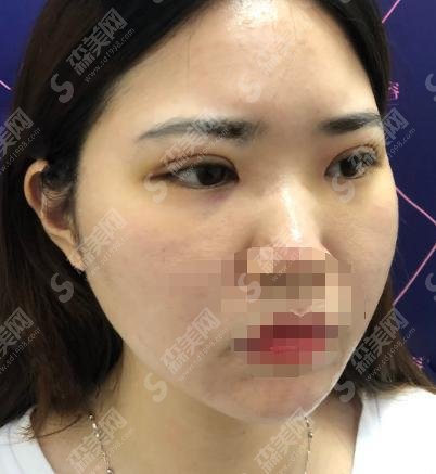 广州美莱名气高，热玛吉除皱果好附真实案例恢复过程