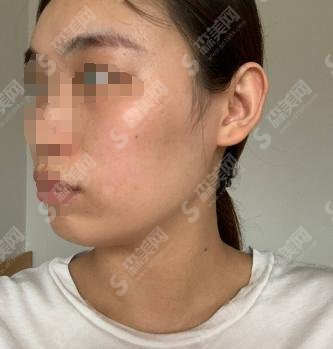 广州华美热玛吉手术果如何？术后果实拍照片加价格表分享