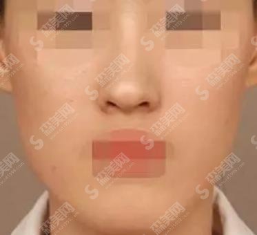 上海美立方美容整形医院医生实力好不好?面部提升手术果好喜欢