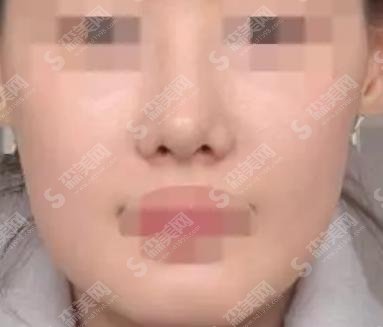 上海美立方美容整形医院医生实力好不好?面部提升手术果好喜欢