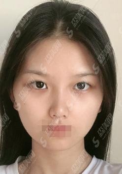 北京八大处哪位医生双眼皮做的好？附医生介绍及医生实操案例分享，明星同款芭比电眼，让你看见更美的自己