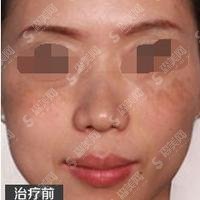 益阳市中心医院整形美容科祛疤果好不好？详细案例一看便知，脸上或者身上有疤的妹子们要注意仔细看了