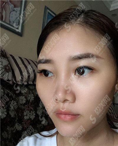 成都铜雀台医院做的双眼皮怎么样?双眼皮的手术安排上之后改变真的特别大,会说话的大眼睛特别有吸引力!