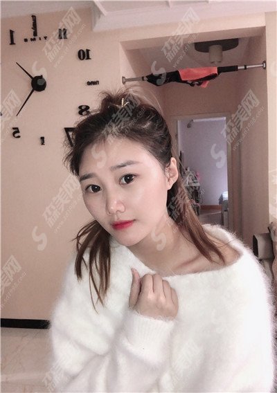 成都铜雀台医院做的双眼皮怎么样?双眼皮的手术安排上之后改变真的特别大,会说话的大眼睛特别有吸引力!