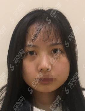 热玛吉在哪里做比较好?上海华美做的热玛吉如何？坐诊的医生技术怎么样？热玛吉恢复过程！