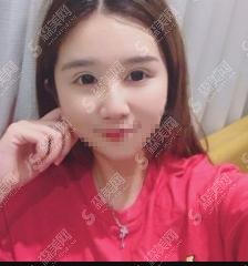 河北医科大学第一医院整形科做的双眼皮真的很漂亮！附医生介绍和医院较新整形价格！