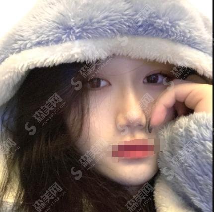 二一一医院整形科做的隆鼻前后对比,坐诊医生技术如何?附案例和价格表较新!
