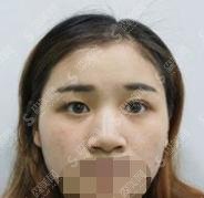 开眼角塑型手术哪家强？进来看看案例你会得到想要的答案，想要成为大眼睛，就看开眼角，案例让你惊艳