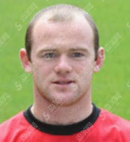 鲁尼植发后果图,看完他的案例,不妨为自己选择一家心仪的医院,秃头的姐妹们快来来围观,看看实际果到底咋样