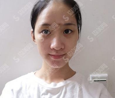 北京深圳医院胡华新所做双眼皮手术如何?医生信息公布/价格表/案例果