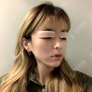 贵阳美尚晟整形医院怎么样?技术实力/口碑/团队都是你心目中的样子吗?双眼皮案例的果图在线浏览!