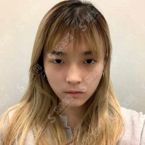 贵阳美尚晟整形医院怎么样?技术实力/口碑/团队都是你心目中的样子吗?双眼皮案例的果图在线浏览!