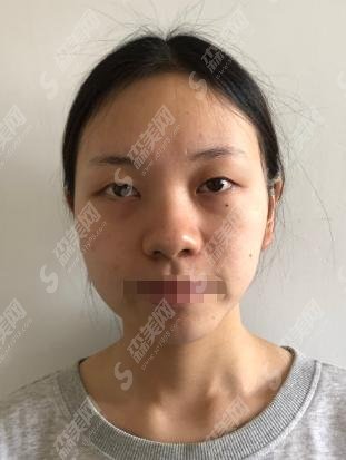 谷琪医生做的双眼皮果怎么样？谷琪医生坐诊医院口碑如何！完美案例给你呈现！