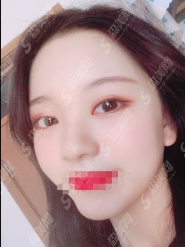 谷琪医生做的双眼皮果怎么样？谷琪医生坐诊医院口碑如何！完美案例给你呈现！