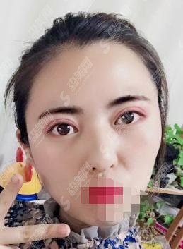 上海伊美尔港华医院如何？徐军医生技术怎么样？医院做的双眼皮恢复过程一览+较新双眼皮价格出炉！