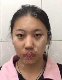 北京隆鼻专家一一介绍！附隆鼻案例+隆鼻价格一览，技术完全不用担忧！赶快围观！