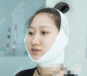 穆雄铮磨骨案例,附2021价格表参考!医生相关信息了解