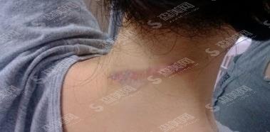 苏印军治疗疤痕怎么样？医生技术如何/案例果/费用查询