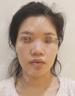 东莞市人民医院整形科优质医生刘小容、刘玉生如何？医院做的隆鼻果对比差距大？附隆鼻价格一览！