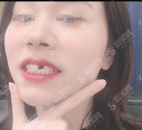 德阳市第三人民医院口腔科值得去吗？李莎、宋一平等医生口碑如何？附牙齿种植术后恢复过程和较新种植价格！