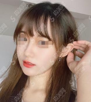 大连董萍整形医院做的隆鼻案例果如何？优选医生爆出！医院较新价格出炉！