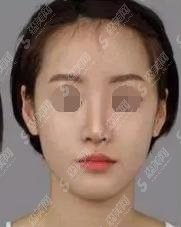 溧阳市人民医院整形科瘦脸价格表较新出炉，追美者可以尽情选择项目！