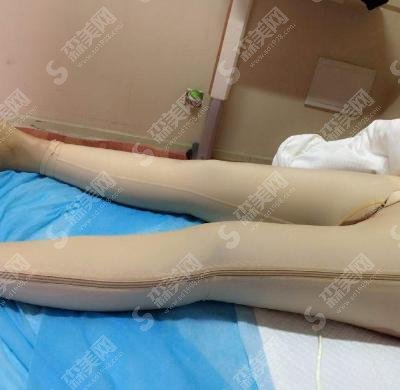 沧州中心医院整形科大腿吸脂果一绝，完美案例实时呈现！