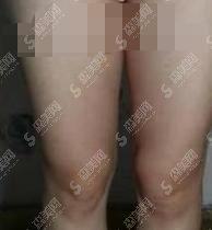 沧州中心医院整形科大腿吸脂果一绝，完美案例实时呈现！