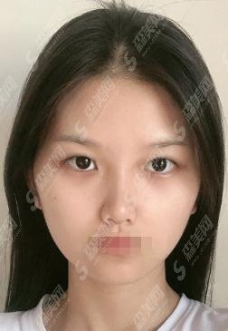 温州附一医整形科价格表上新!温州附一医院做的双眼皮果堪称完美!完美的案例还不快码住?