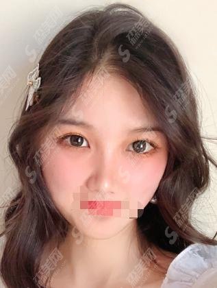 温州附一医整形科价格表上新!温州附一医院做的双眼皮果堪称完美!完美的案例还不快码住?