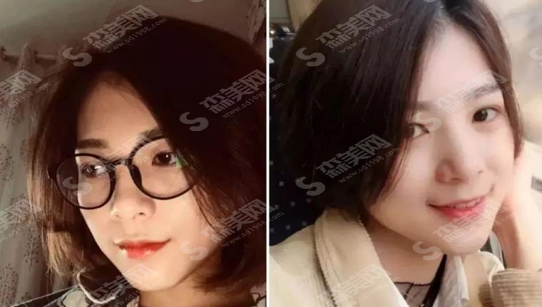 郑州近视矫正手术医院排名,口碑好的有郑州眼科/新视界/中心医院,附矫正案例