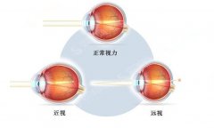 郑州近视眼手术医院排名榜公布，艾格|瑞普|五附院眼科简介，附近视眼手术案例