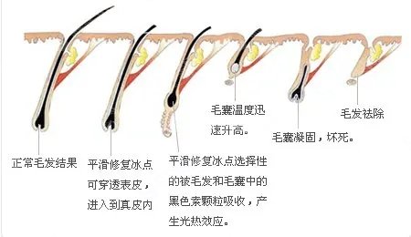 上海激光脱毛价格一览表在线查询&激光脱毛技术/恢复/流程/果在线同步分享值得一看!