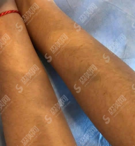 上海激光脱毛价格一览表在线查询&激光脱毛技术/恢复/流程/果在线同步分享值得一看!