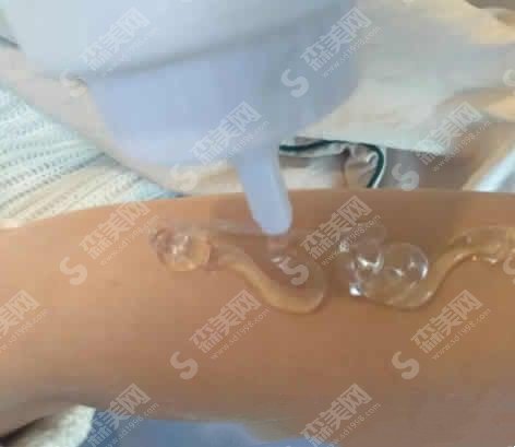 上海激光脱毛价格一览表在线查询&激光脱毛技术/恢复/流程/果在线同步分享值得一看!