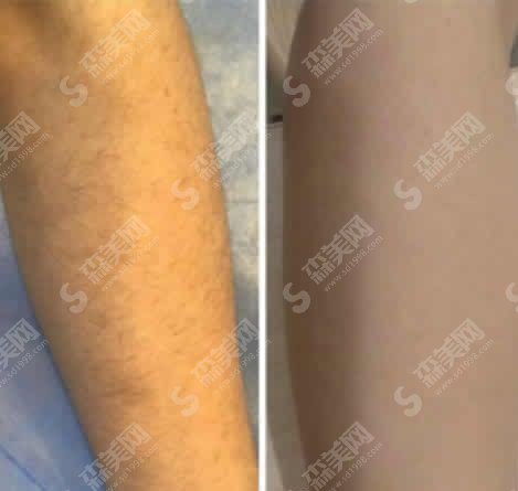 上海激光脱毛价格一览表在线查询&激光脱毛技术/恢复/流程/果在线同步分享值得一看!