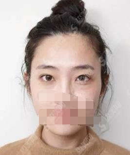 常州美莱整形美容医院，医院简介和医院医生详情以及祛眼袋案例果带给大家！