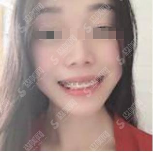 贵阳市口腔医院价格表查询,附牙齿矫正案例