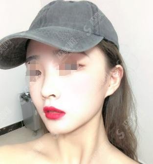 上海悦薇堂整形价格表新鲜爆料!医生技术怎么样?附双眼皮案例!