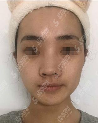 上海悦薇堂整形价格表新鲜爆料!医生技术怎么样?附双眼皮案例!