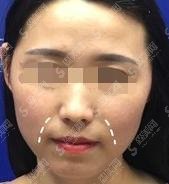 2021上海热玛吉官方授权医院有哪些?华山医院舒适不错,快来瞧瞧!