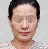 成都二医院整形科做热玛吉口碑,靠谱的整形医院推荐!