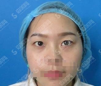 2021齐鲁医院李秀琪双眼皮案例果实在是太完美了，术后较为自然！