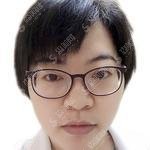 2021齐鲁医院李秀琪双眼皮案例果实在是太完美了，术后较为自然！